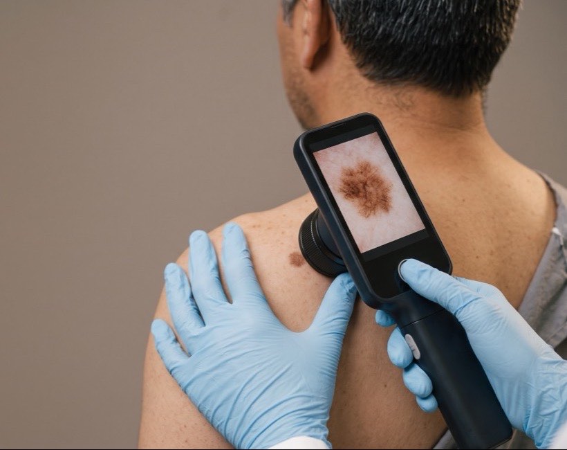Dermatoscopio digital apoyado sobre un lunar del hombro