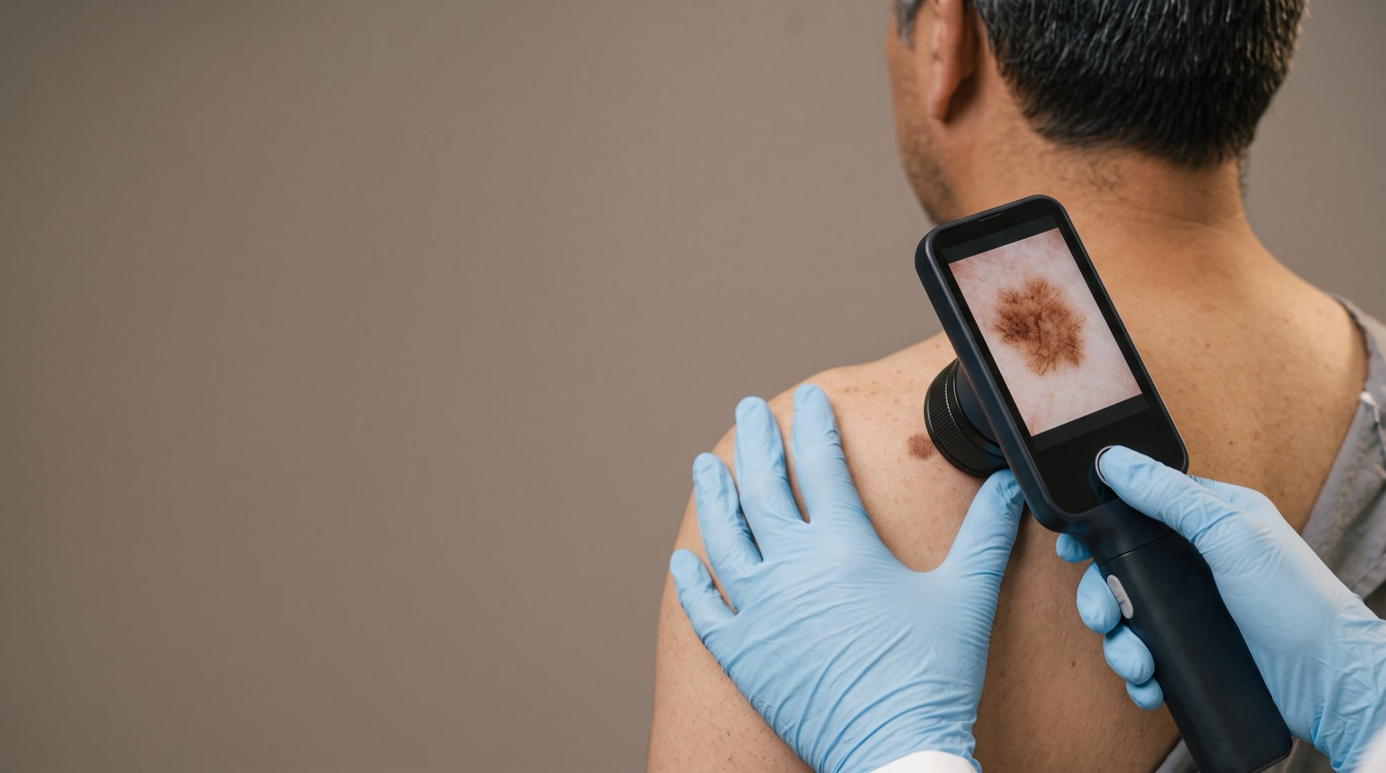 Una especialista revisa un lunar en la espalda de un paciente con un dermatoscopio digital.